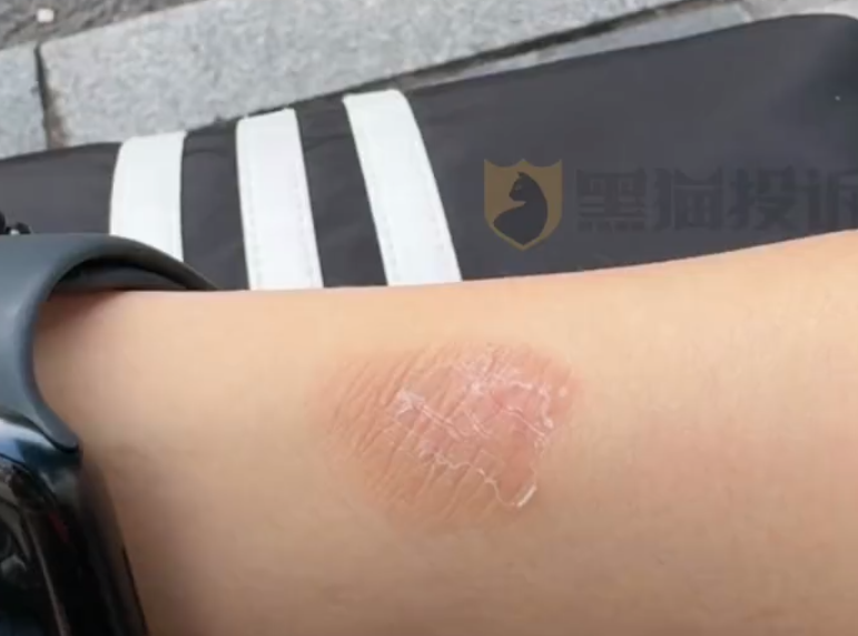 女子戴Apple Watch睡觉被烫伤起泡 苹果客服回应：过敏反应 - Apple Watch  (https://www.qianyan.tech/) 头条 第2张