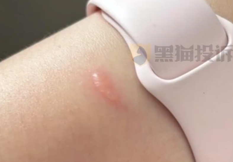 女子戴Apple Watch睡觉被烫伤起泡 苹果客服回应：过敏反应 - Apple Watch  (https://www.qianyan.tech/) 头条 第1张